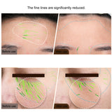 Before and after comparison showing reduced appearance of forehead and under-eye fine lines after RF EMS use