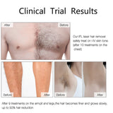Clinical trial before and after results of IPL laser hair removal – up to 92% reduction in hair
