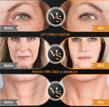 Before and after images illustrating a lifted, smoother look on the face with consistent RF EMS use