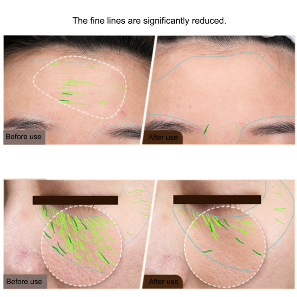 Before and after comparison showing reduced appearance of forehead and under-eye fine lines after RF EMS use